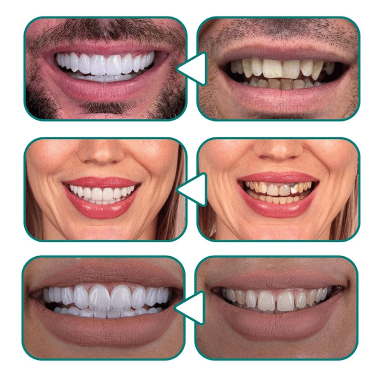 😁✨ Snap-On Smile® – ابتسامة مثالية في ثوانٍ